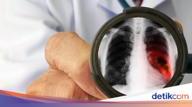 Ini yang Terjadi pada Paru-paru saat Terkena Pneumonia