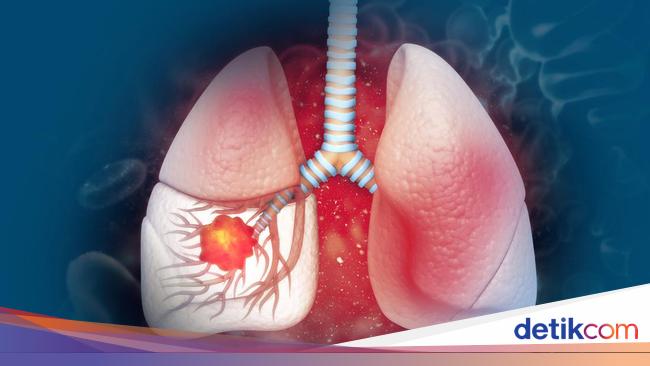 Kenapa Kanker Paru Kerap Tidak Bergejala? Ini Penjelasan Profesor Pulmonologi